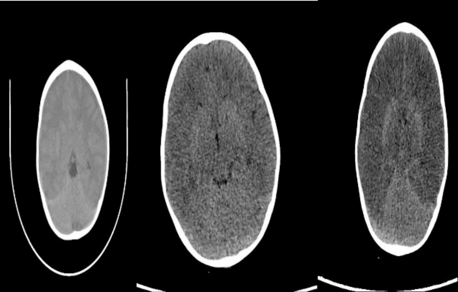 Fatal Late-Onset Presentation of Ornithine Transcarbamylase (OTC) Deficiency: A Case Report Highlighting Diagnostic Challenges and Cerebral Complications