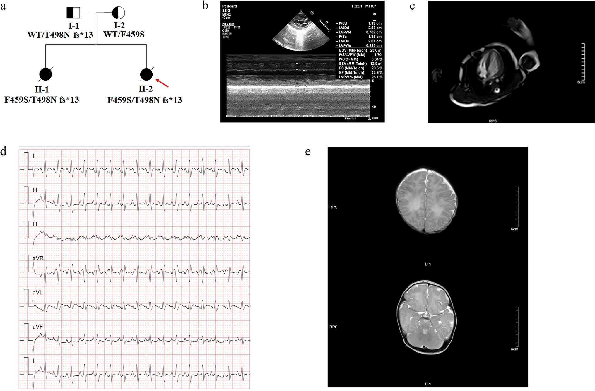 Clinical characteristics and induced pluripotent stem cells (iPSCs) disease model of Harel–Yoon syndrome caused by compound heterozygous ATAD3A variants