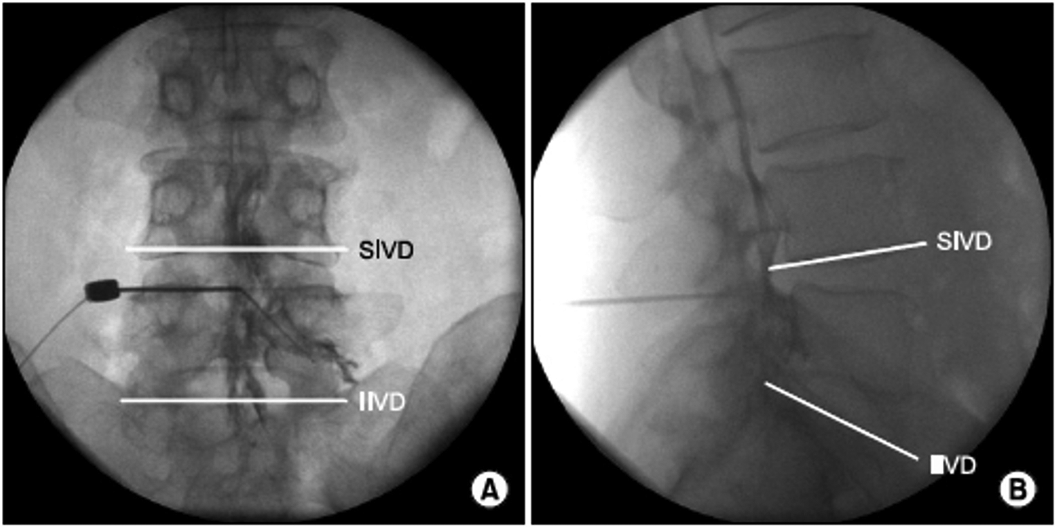 Epidural Contrast Patterns and Clinical Implications: An Educational Review