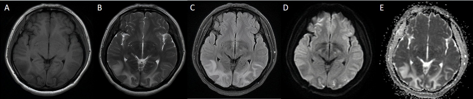 Cross-sectional analysis of posterior reversible encephalopathy syndrome in pregnant women with and without HELLP syndrome