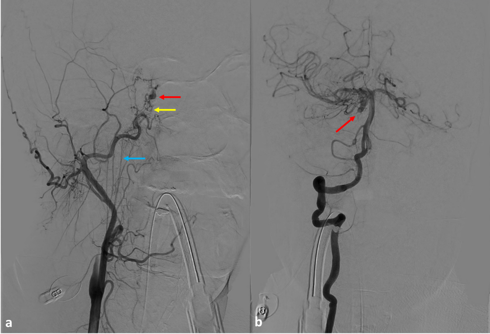 Carotid reconstitution in chronic dissection
