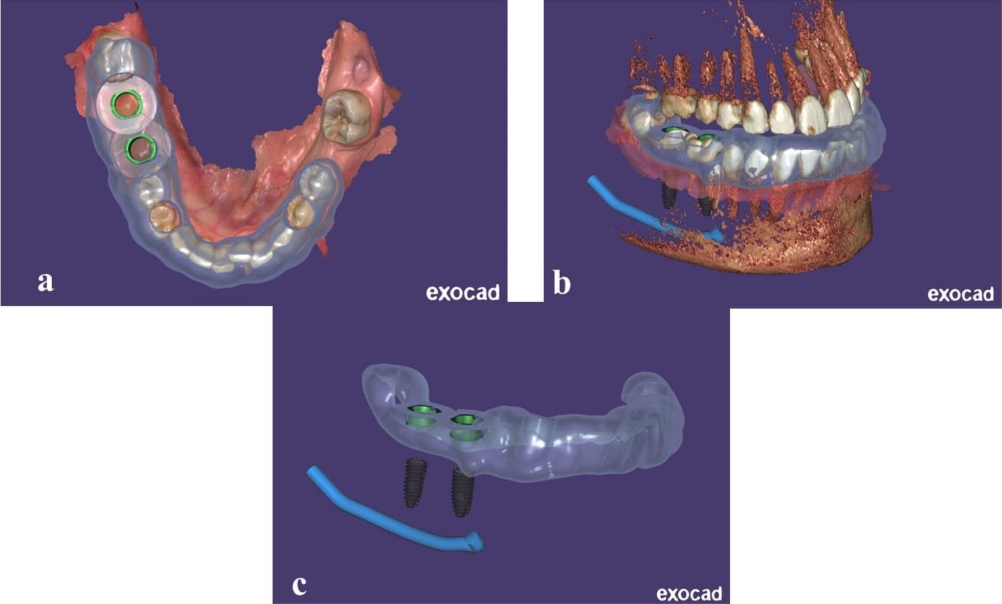 Early versus conventional loading for fully guided immediate implant placement in molar sites: a randomized controlled clinical study