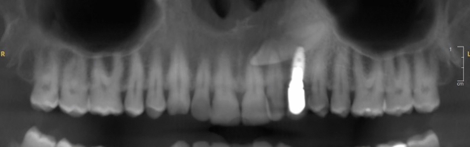 Management of an infectious complication appearing in a transcanine implant: a case report