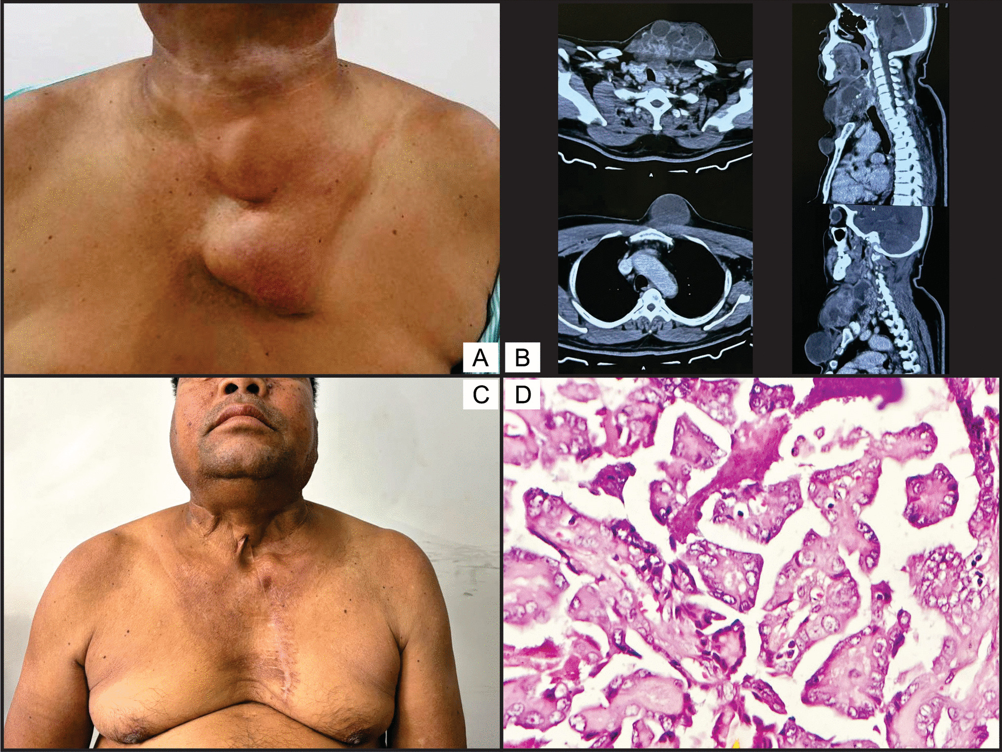 Presternal Papillary Thyroid Carcinoma: A Pretracheal Fascia Paradox