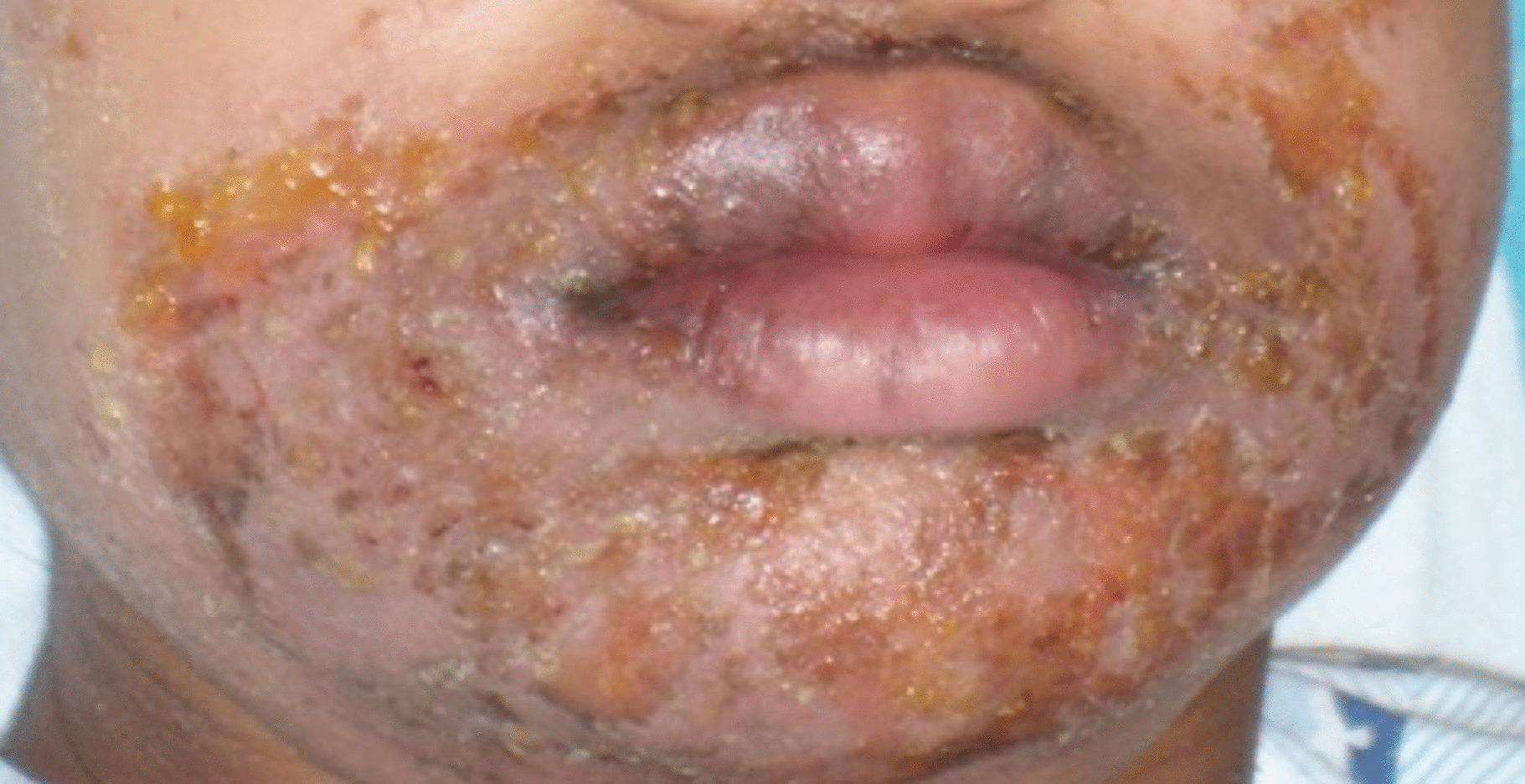A Review of Common Pediatric Skin Infections