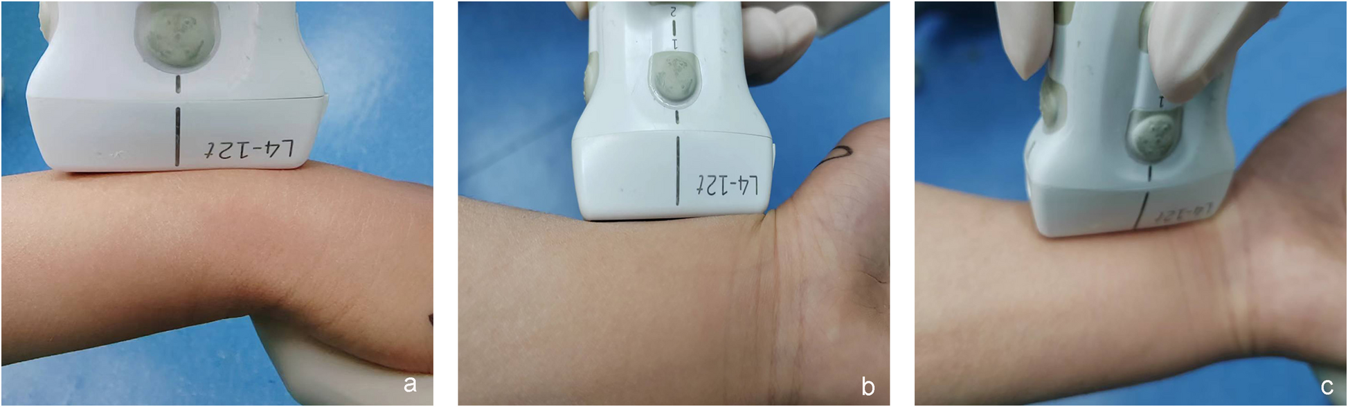 Ultrasound-guided closed reduction of distal radius Salter-Harris I and II fracture in children