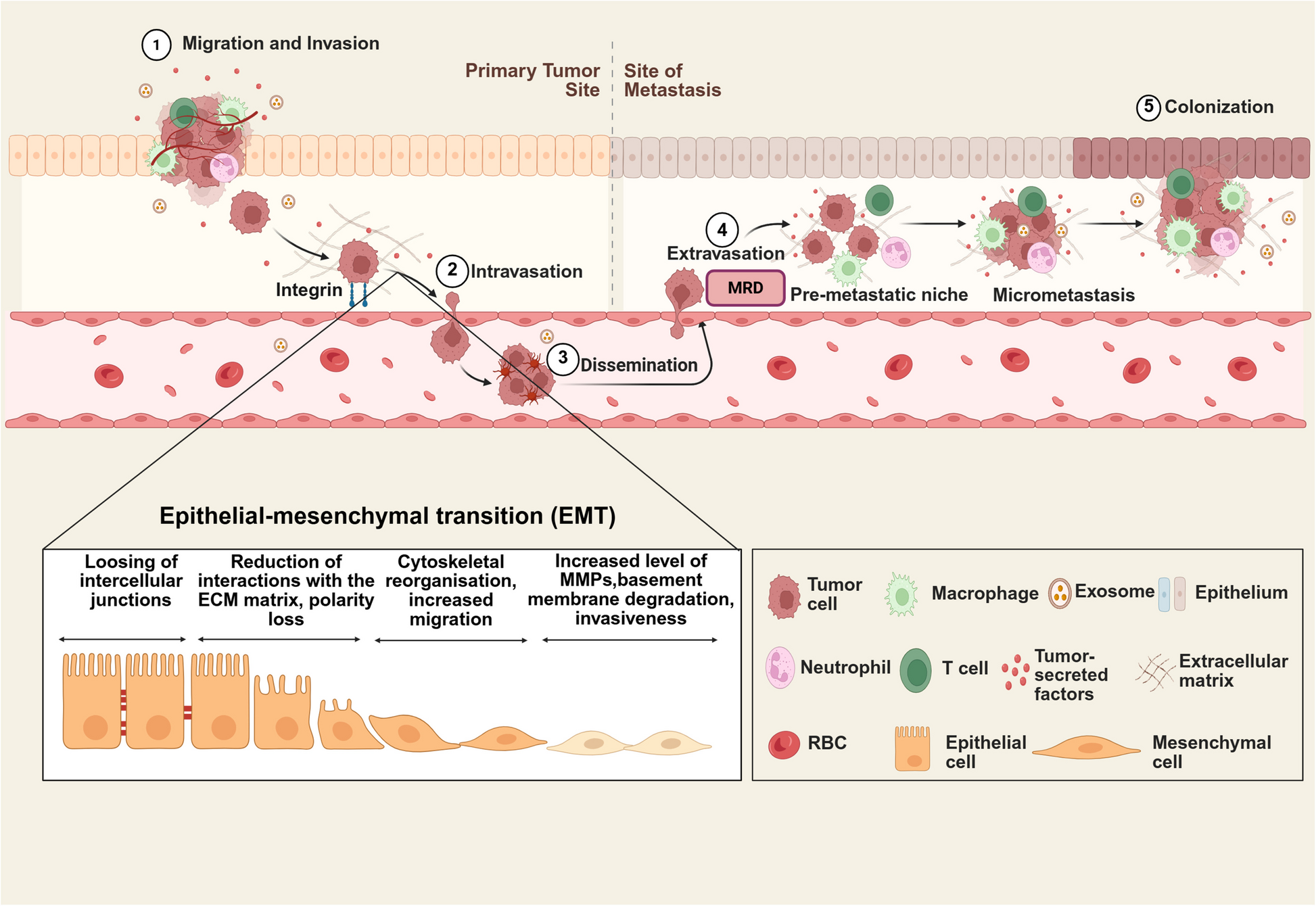 Epithelial-to-mesenchymal transition (EMT) and cancer metastasis: the status quo of methods and experimental models 2025