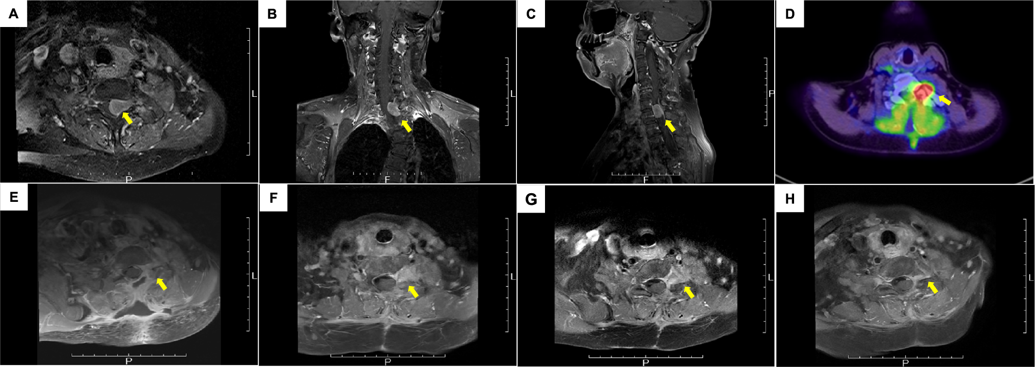 A rare case of ALK-positive histiocytosis with neurological involvement in a 70-year-old woman successfully managed with partial resection and alectinib