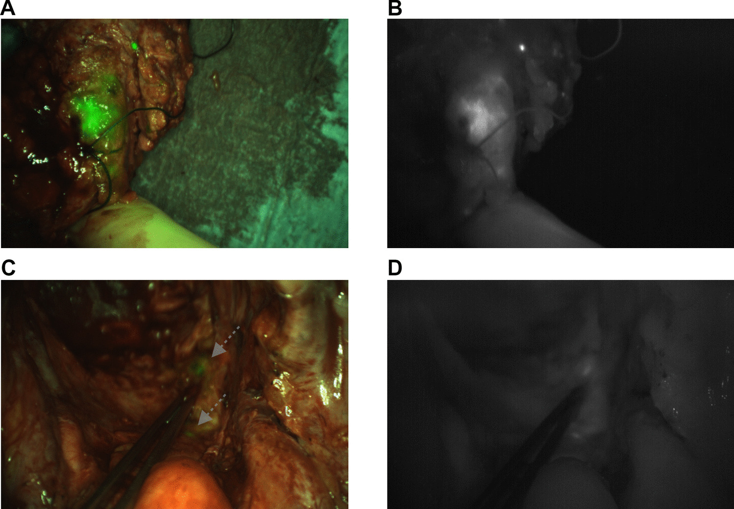 Long-term Local Control Following CEA-targeted Fluorescence-guided Surgery in Patients With Locally Advanced and Recurrent Rectal Cancer