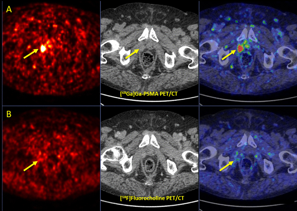 [Ga]Ga-PSMA-11 PET/CT and [F]Fluorocholine PET/CT in Assessment and Clinical Decision Making of Recurrent Prostate Cancer: A Prospective Crossover Trial