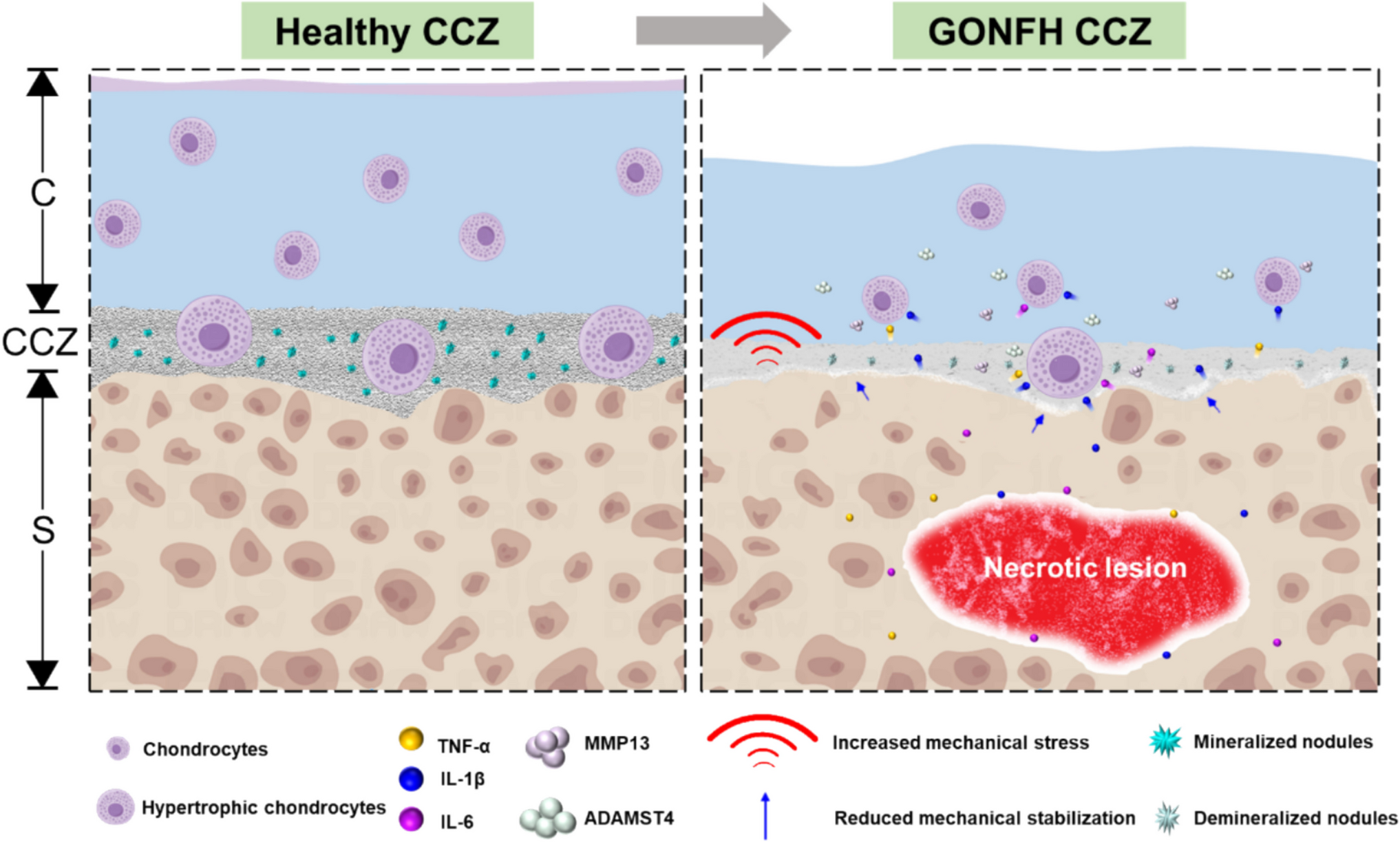 Calcified Cartilage Zone Remodeling Induced by IL-1β Derived from Necrotic Subchondral Bone Initiates Cartilage Degeneration in Patients with Glucocorticoids-induced Osteonecrosis of the Femoral Head