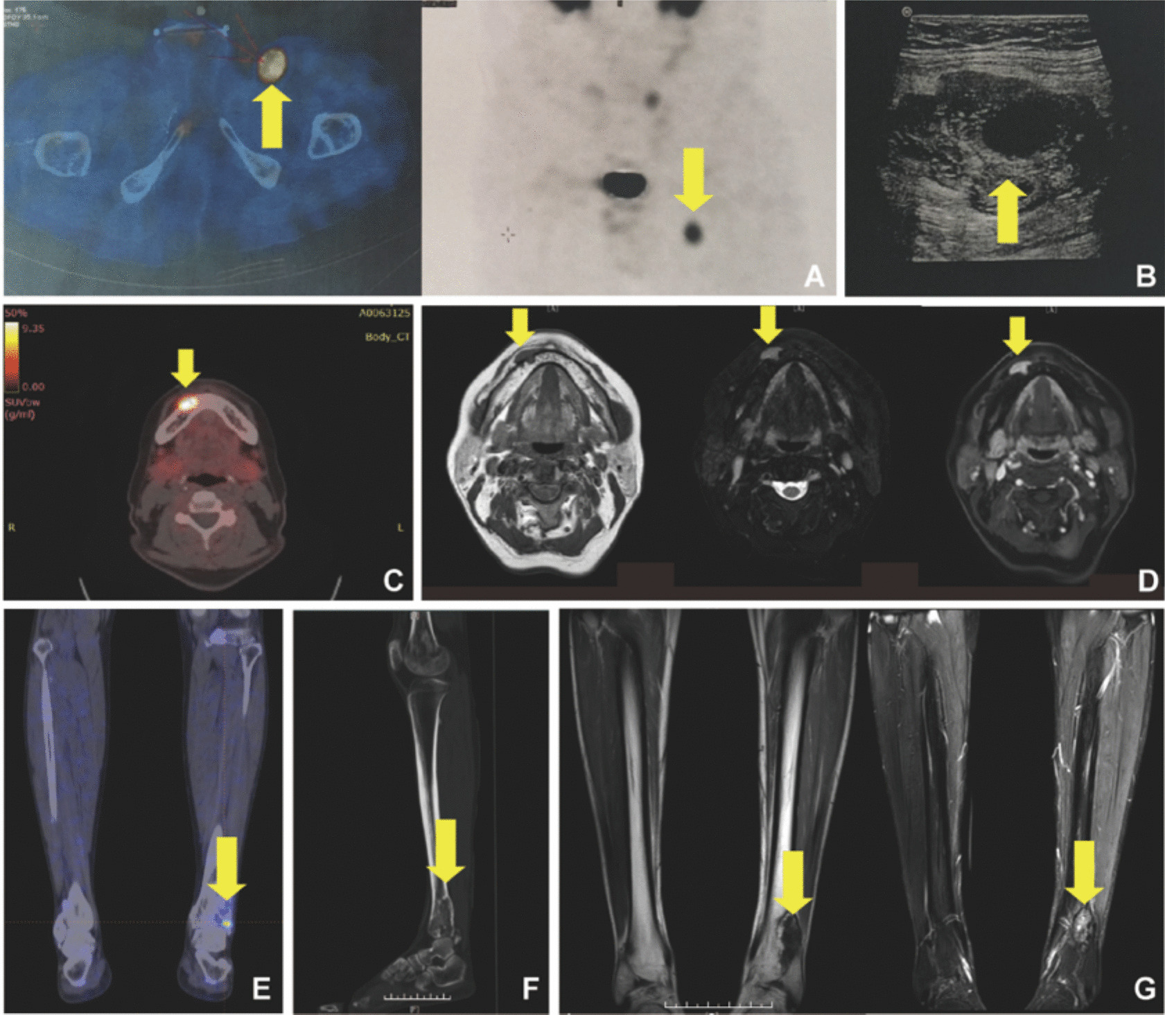 Postoperative outcome and clinical management of tumor-induced osteomalacia: a single-center retrospective cohort study on 117 patients