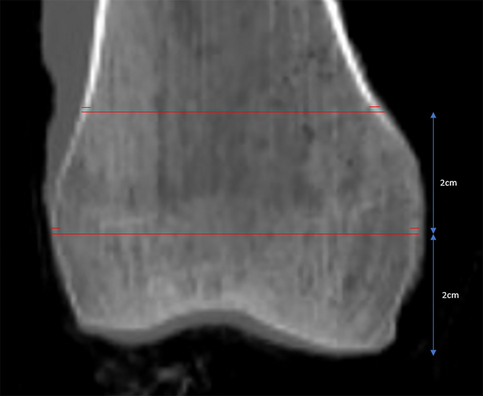 Trabecular bone score predicts distal femur screw pull-out strength better than DXA bone mineral density, CT Hounsfield units, and cortical density