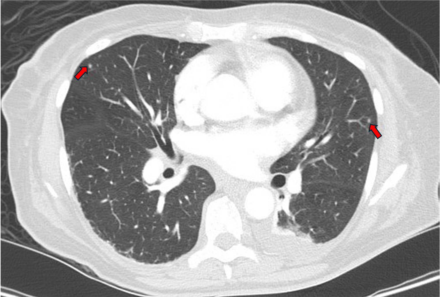 Disseminated tuberculosis in a patient treated with ruxolitinib for primary myelofibrosis