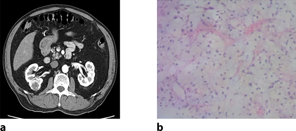 Drug-eluting bead transarterial chemoembolization combined with cryoablation for renal cell carcinoma