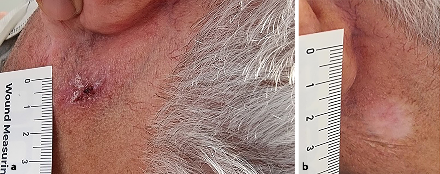 Epidermal radionuclide therapy with rhenium—the new treatment for skin squamous cell carcinoma