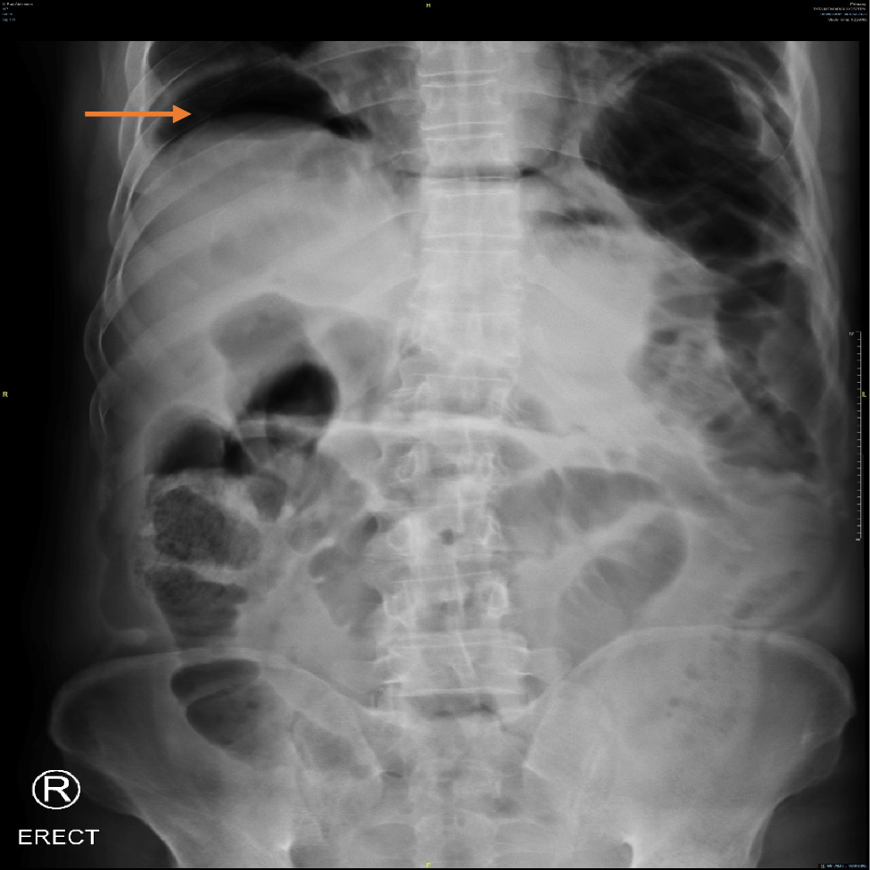 A stitch in time saves nine! A case report of spontaneous duodenal perforation in advanced pancreatic cancer
