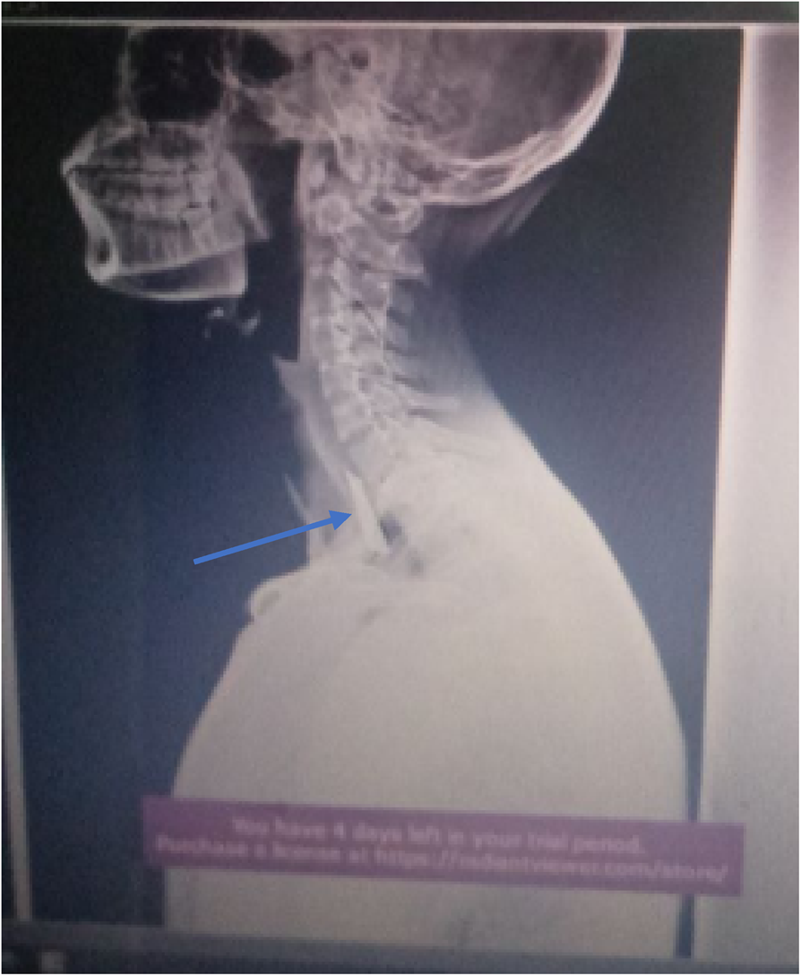 Successful endoscopic removal of sewing needle and flat metal: a case report