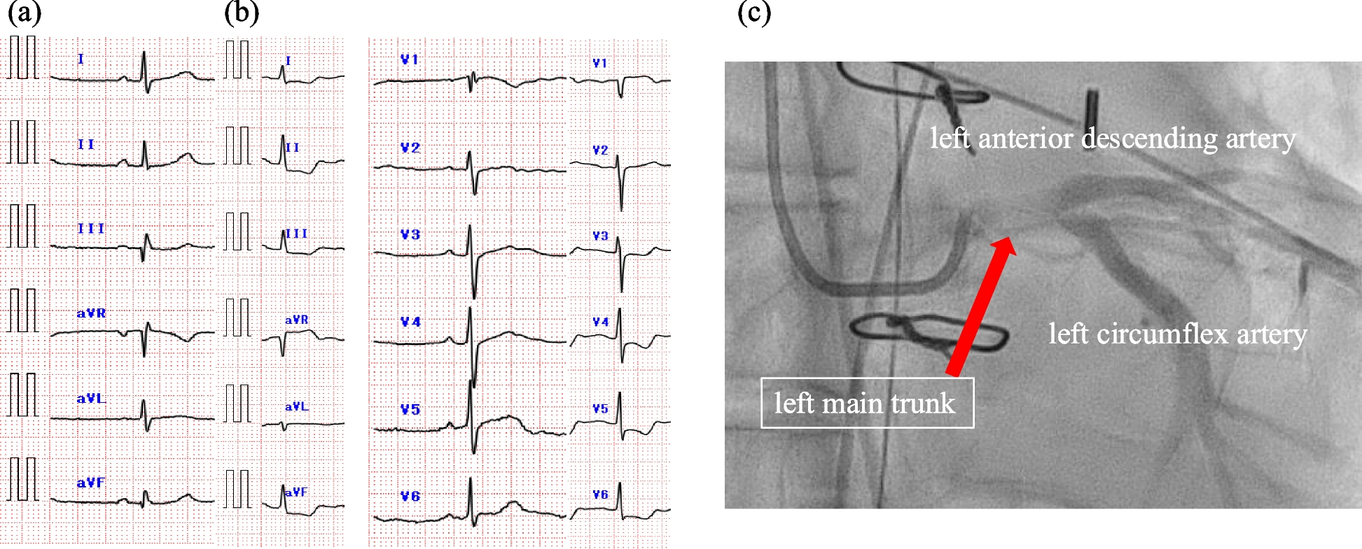 Progressive coronary stenosis detected by intraoperative TEE after acute type-A aortic dissection repair: a case report