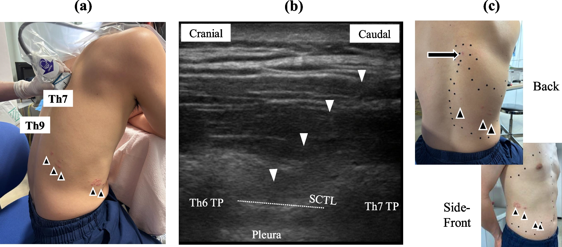 Cephalad intertransverse process block for thoracic herpes zoster: a practical approach to enhance safety and effect