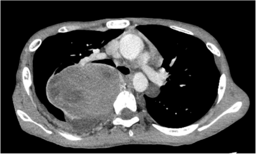 What is safe paravertebral block and neuraxial anesthesia for patients with neurofibromatosis type 1?