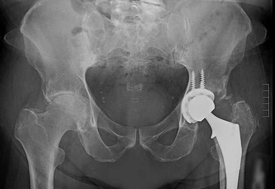 ‘It’s been a life changer’: Complex hip replacement surgery allows doctor to walk upright again