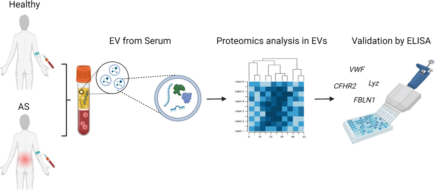 Identifying novel biomarkers for ankylosing spondylitis through proteomic profiling of serum-derived extracellular vesicles