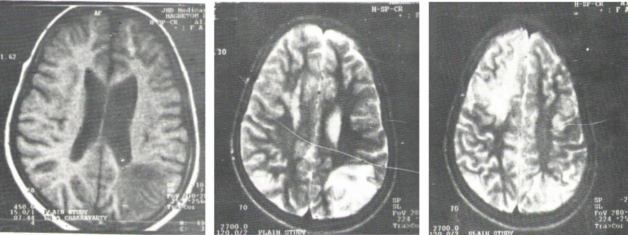 Pitfalls in the Diagnosis of Wilson Disease