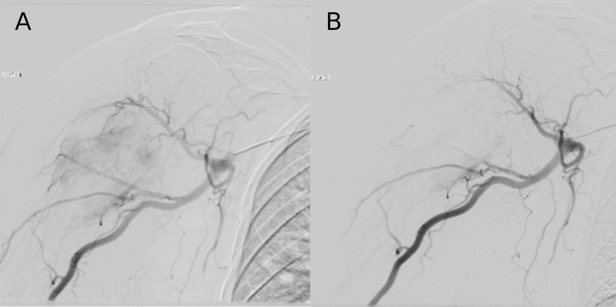 Minimally Invasive Treatment Strategies for Metastatic Disease of the Skeleton: Current Concepts