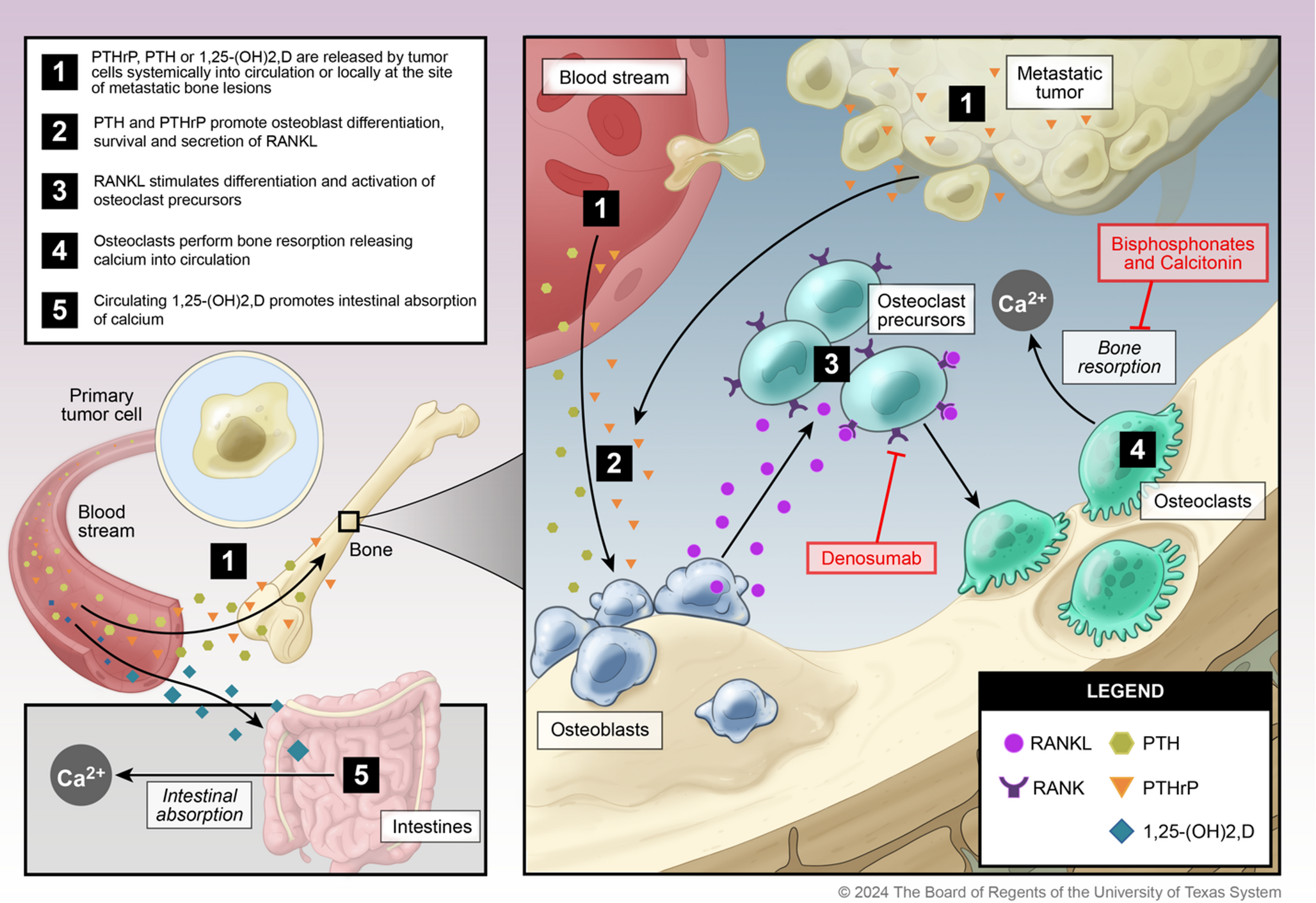 Acute Management of Hypercalcemia of Malignancy – A Review of Pathophysiology, Diagnosis, and Treatment