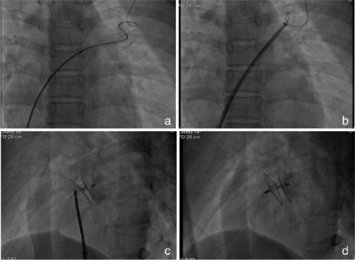 Transcatheter closure of patent foramen ovale in children with migraine or dizziness
