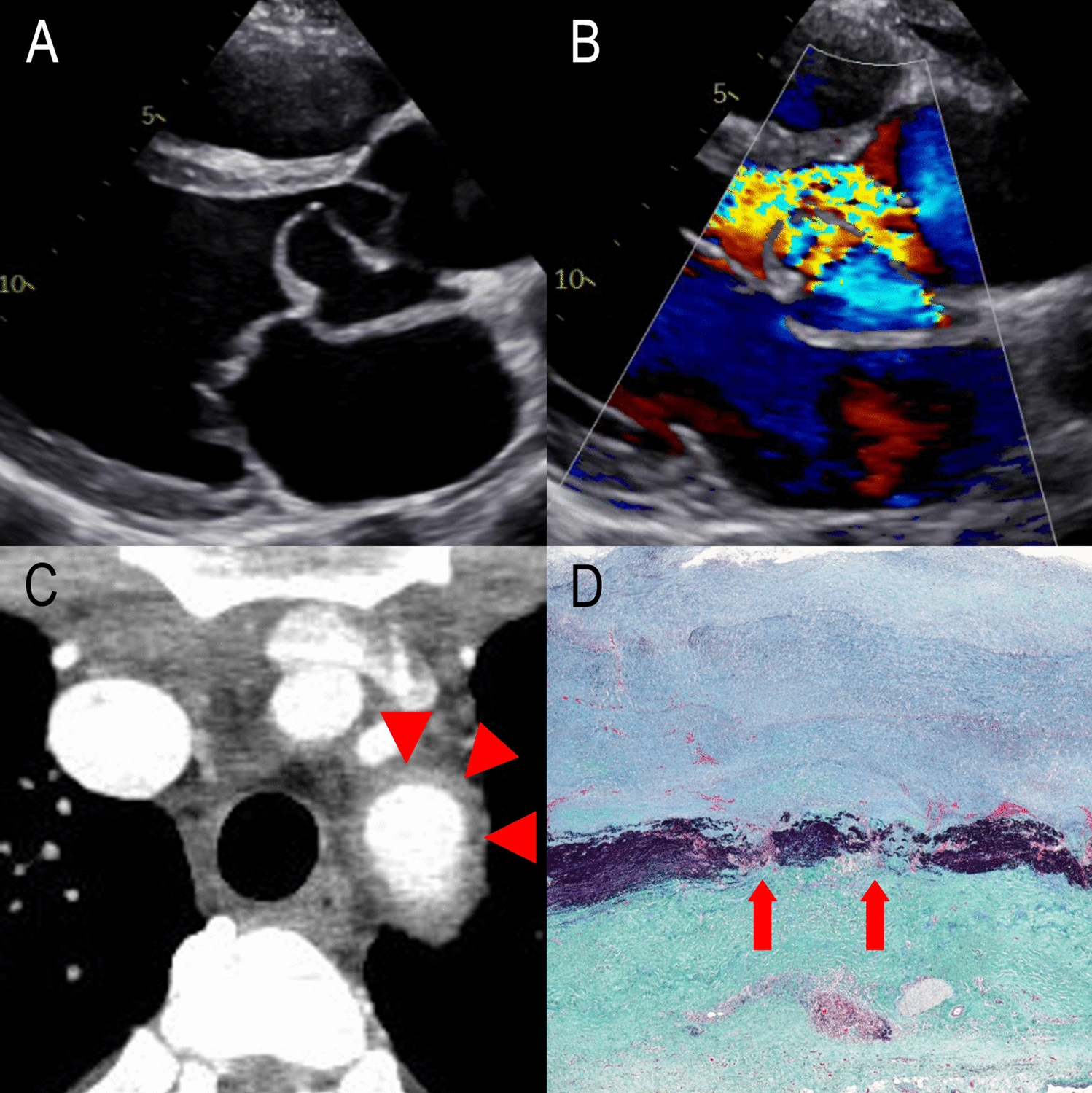 Takayasu arteritis masquerading as an isolated sinus of valsalva dissection in a young adult