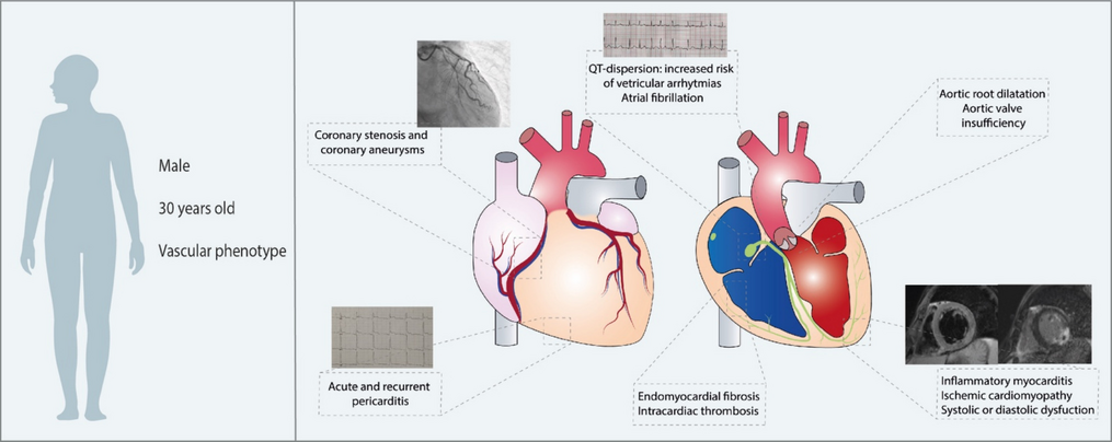 Cardiac Manifestations in Behçet’s Syndrome