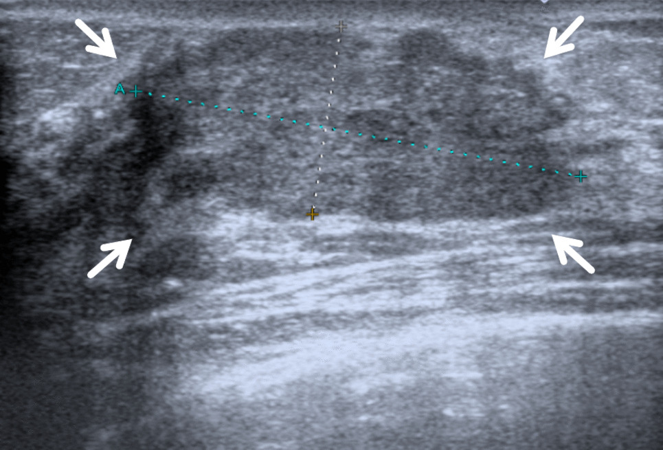 Immunoglobulin G4-related sclerosing mastitis: MRI findings and the literature review