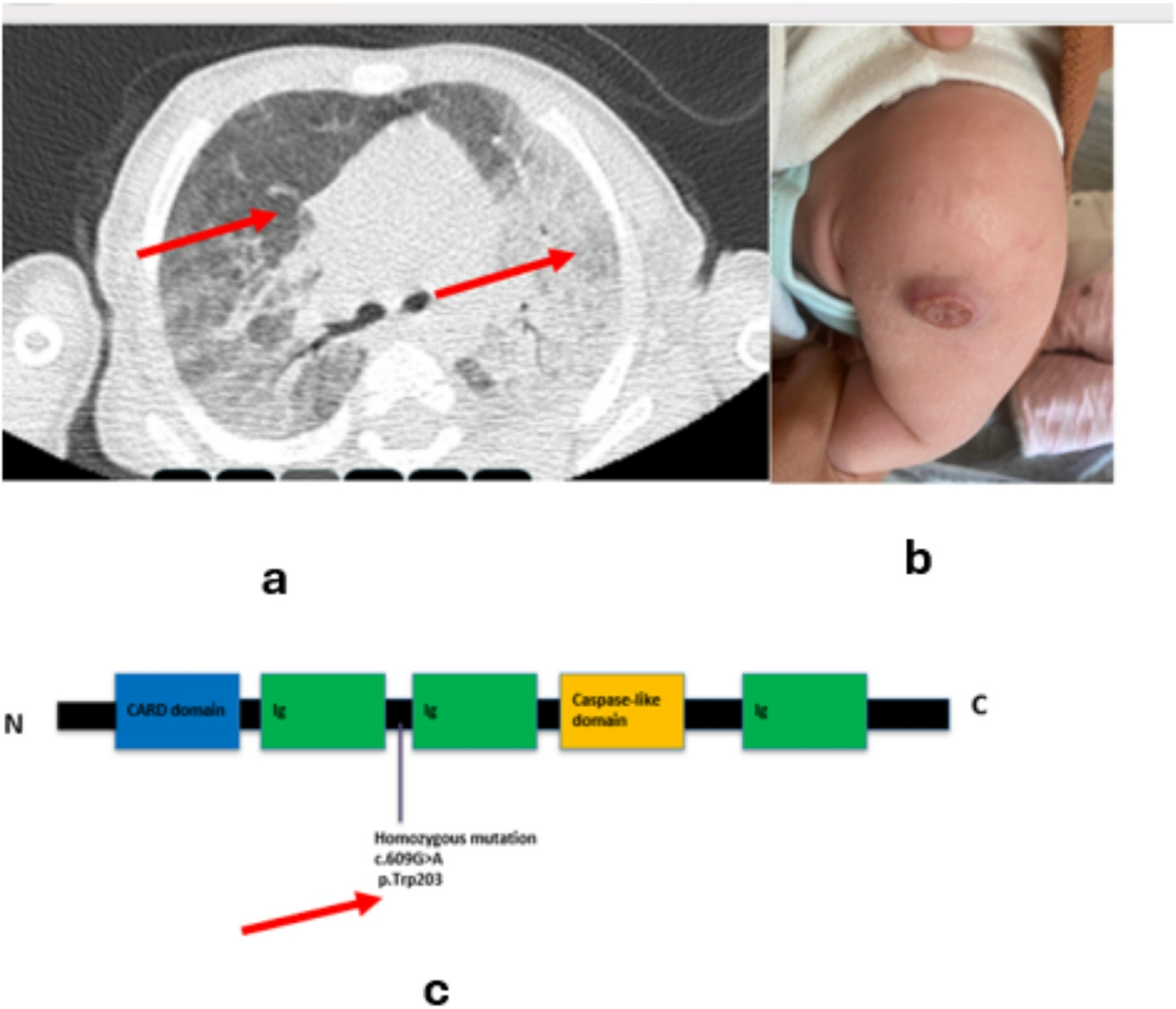 To The Editor a Novel Mutation in MALT1 Deficiency
