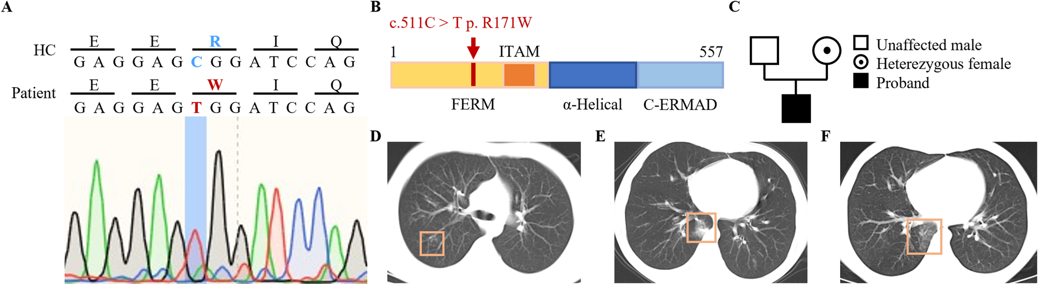 The Immunodeficiency Profile of Lymphocytes in the Patient with  Gene Mutation During Different Infection