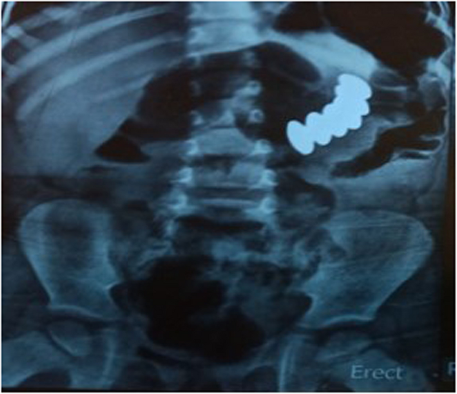 Recognition and management of foreign body ingestion in infants and children: a retrospective study