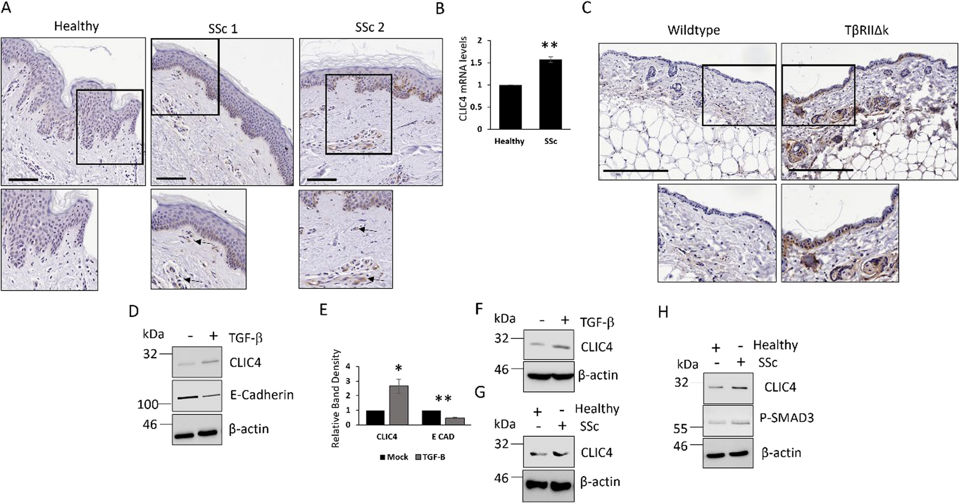 Transforming growth factor beta (TGF-β) induces type 1 interferon signalling in systemic sclerosis keratinocytes through the chloride intracellular channel 4 (CLIC4)