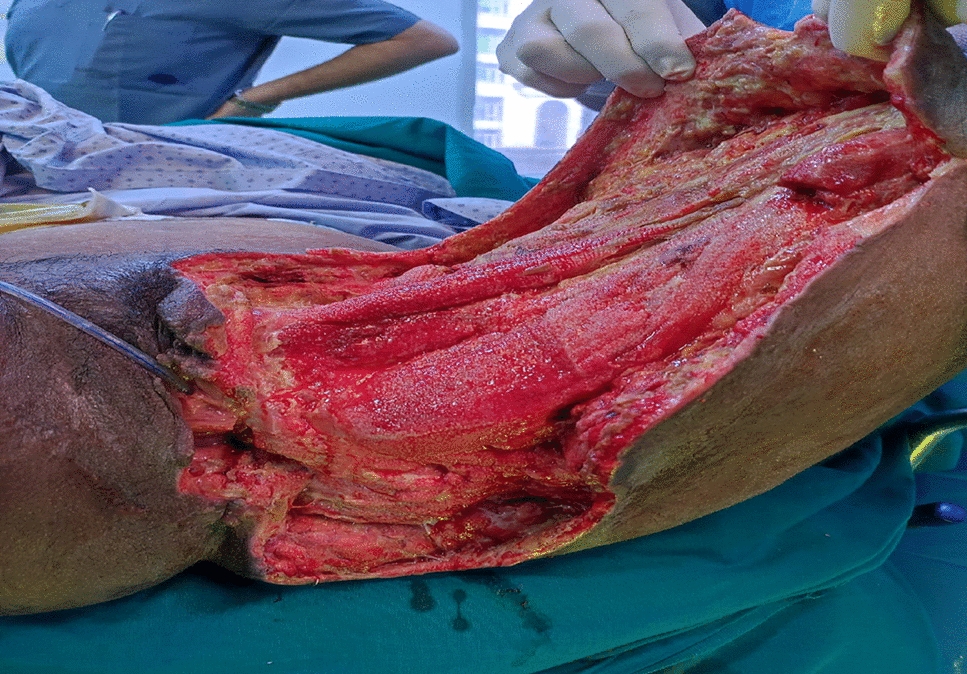 Puerperal Necrotizing Fasciitis: a Case Report