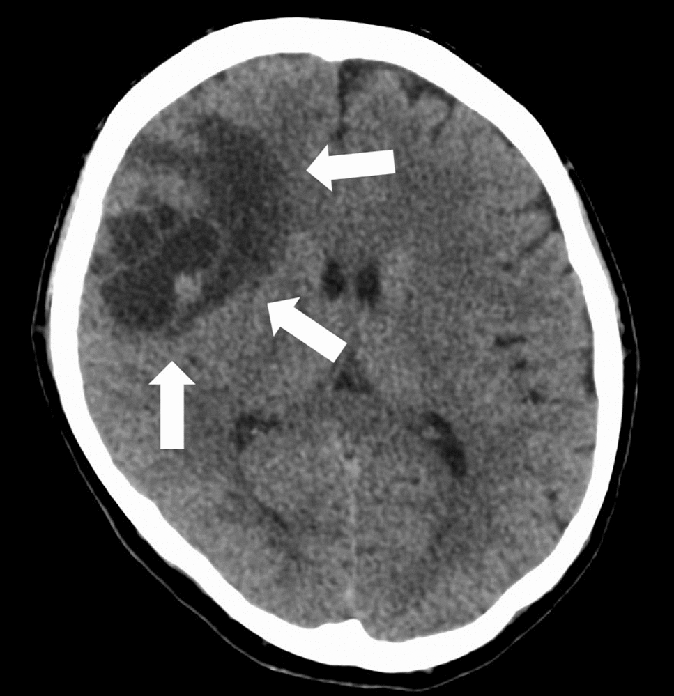 Glioblastoma with Sudden-Onset General Convulsions at 32 Weeks of Gestation