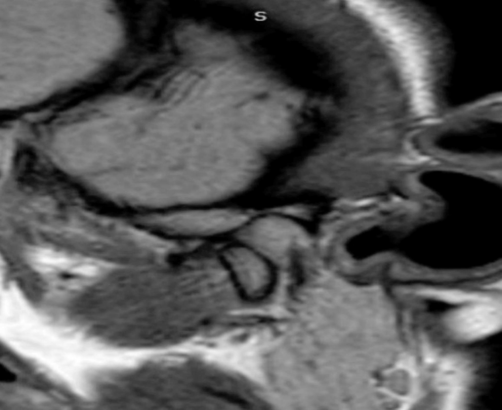 Does ultrasound guidance during arthrocentesis in women with disc displacement without reduction reduce procedure time and improve outcomes? A randomized clinical trial