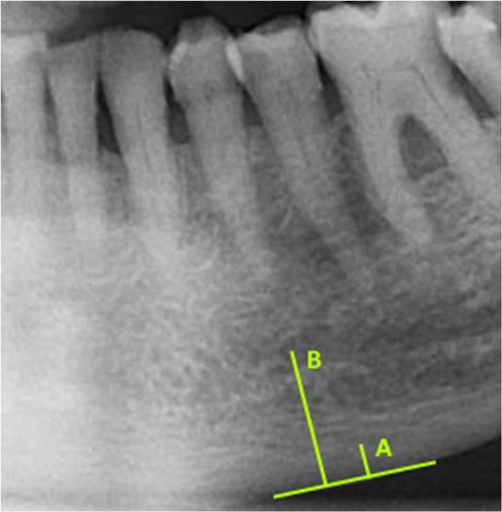 Variation of mandibular radiomorphometric indices in metastatic bone cancer patients undergoing antiresorptive treatment: a prospective study