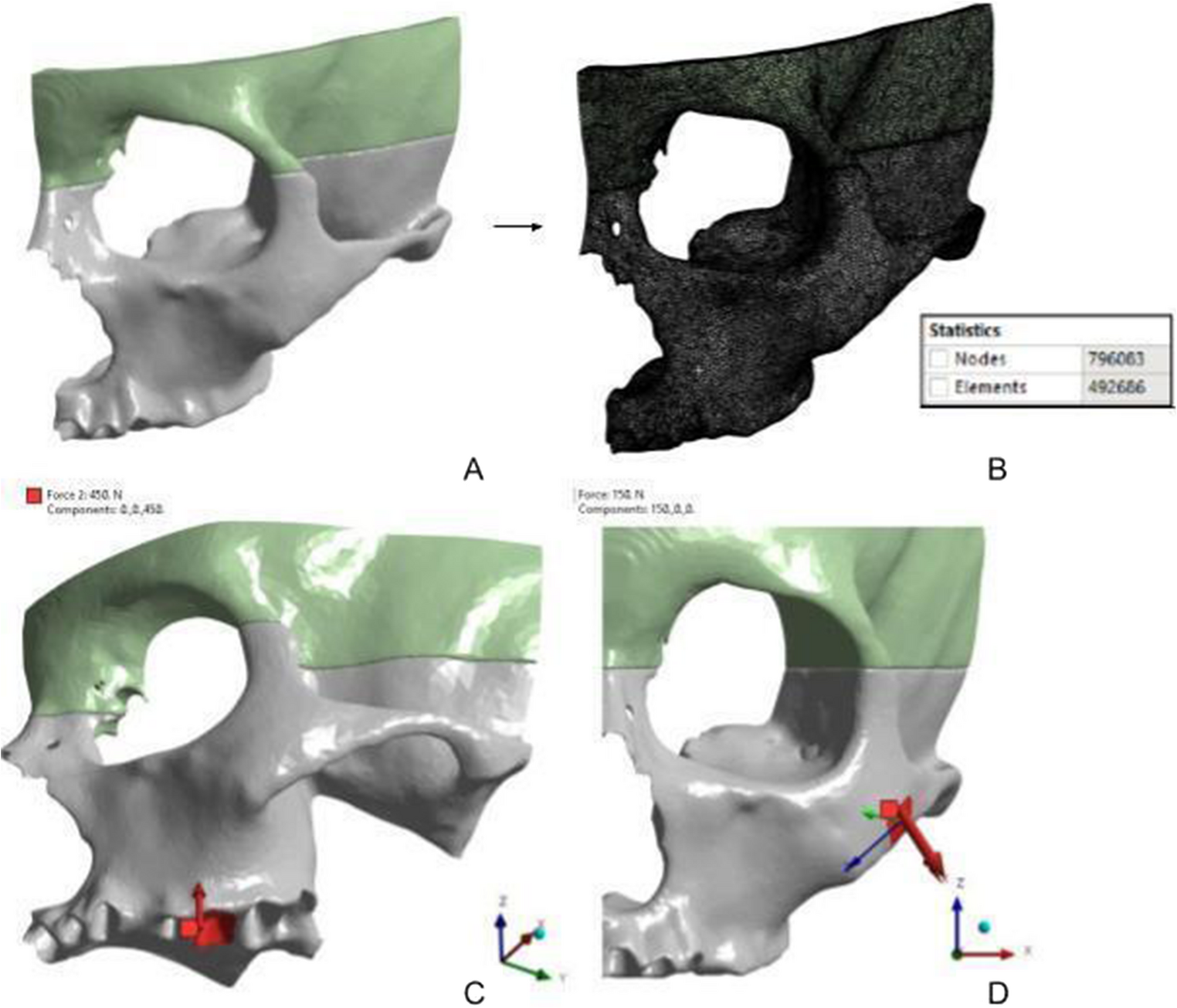 Evaluating von mises stress distribution and deformation patterns in zygomaticomaxillary complex fractures- a finite element analysis study
