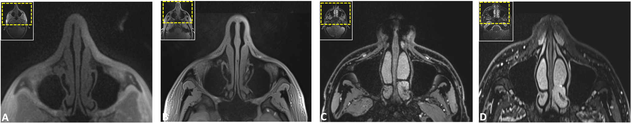 Black bone and CT-like MRI-based delineation of fracture-prone regions in oral and maxillofacial trauma