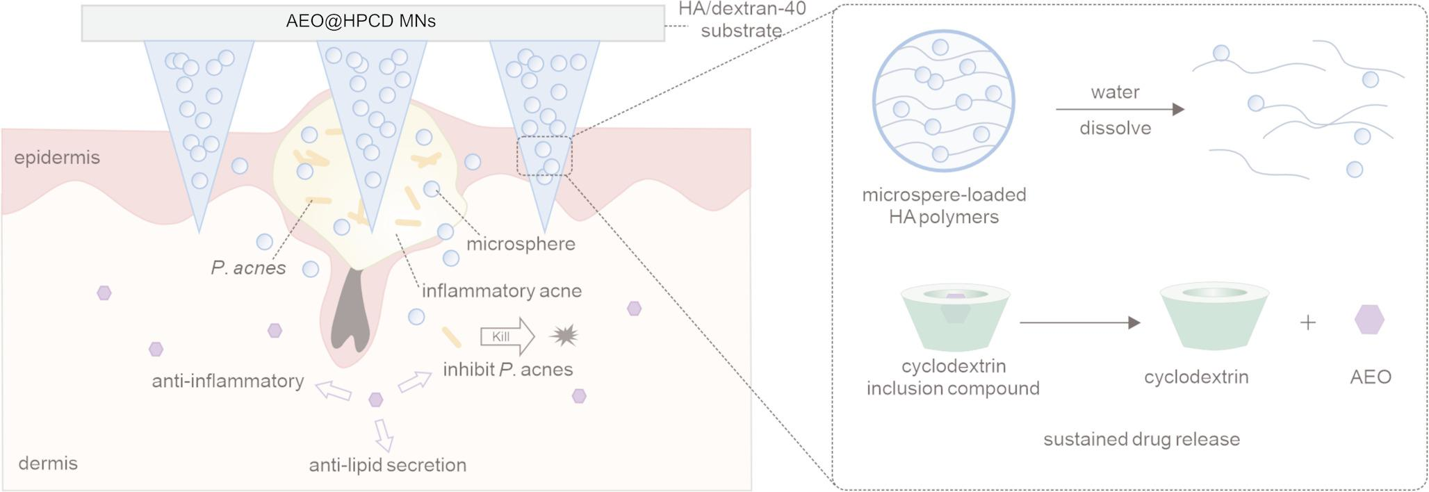 Microneedle-mediated delivery of hydroxypropyl--cyclodextrin-encapsulated  (Danggui) essential oil for acne treatment: efficacy and mechanisms