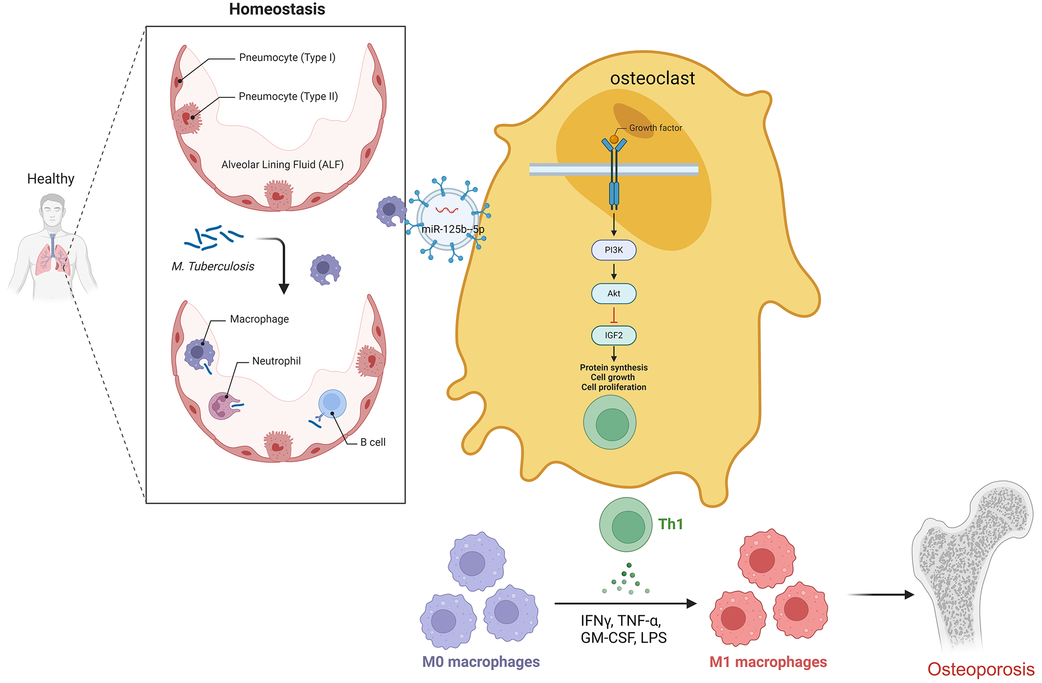 Tuberculosis-infected macrophage exosomal miR-125b-5p induces osteoporosis by targeting IGF2 through the PI3K/AKT pathway
