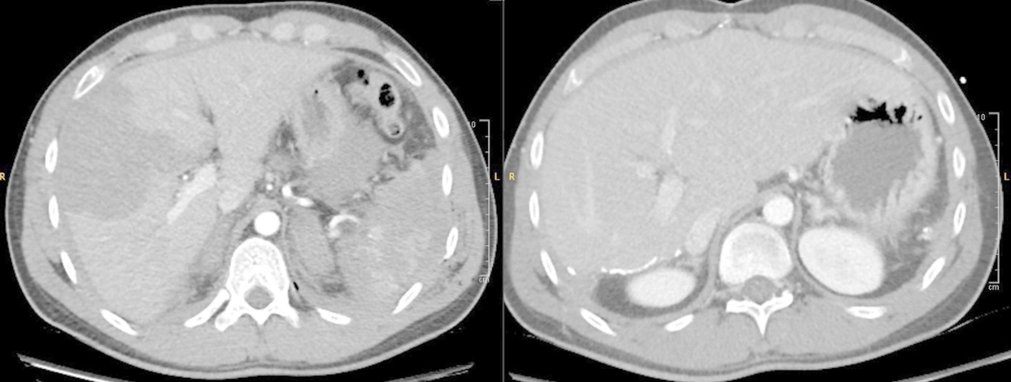 Resolution of traumatic adrenal hemorrhage on CT: impact of follow-up timing and initial hematoma size