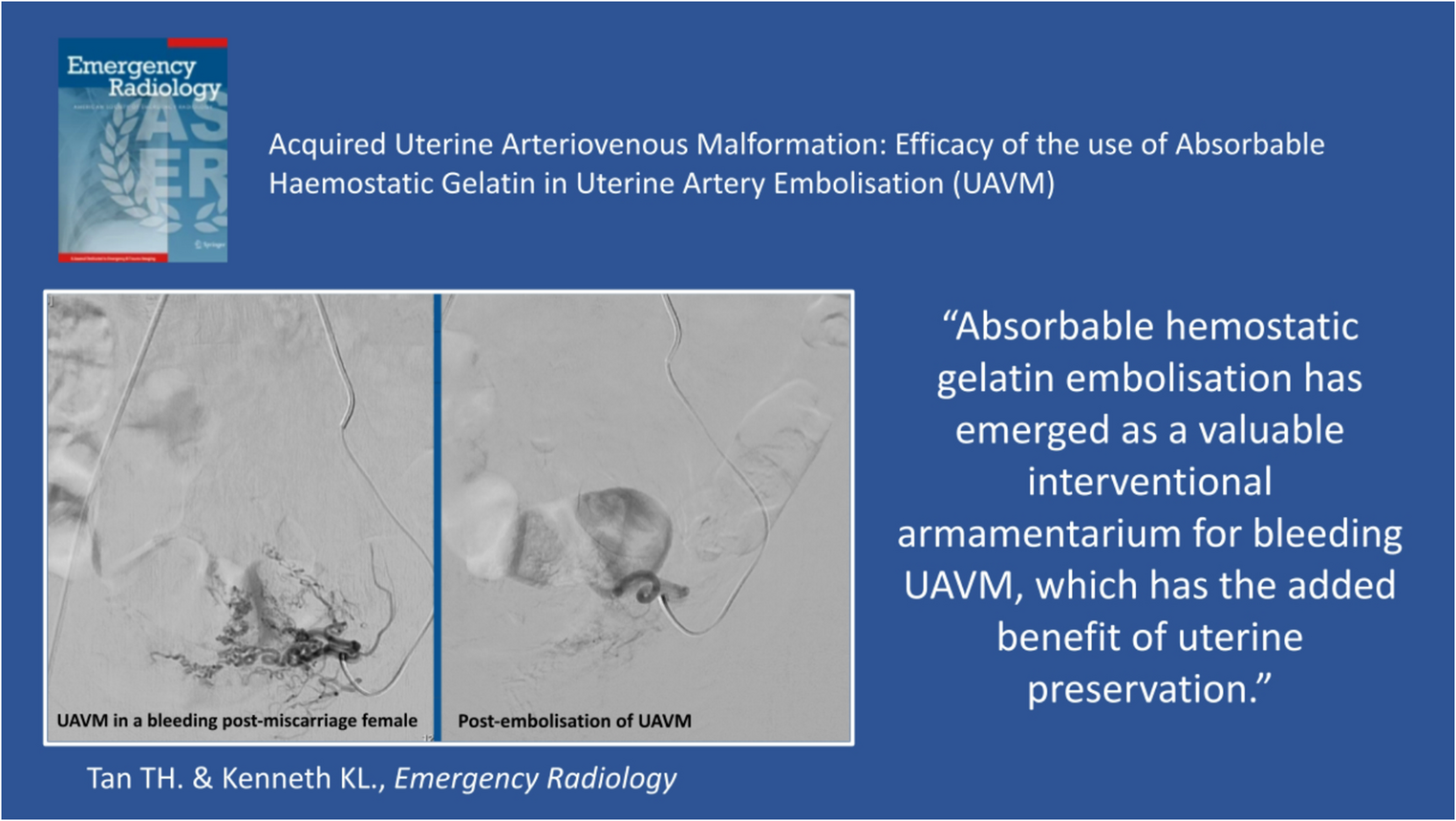 Acquired uterine arteriovenous malformation: efficacy of the use of absorbable haemostatic gelatin in uterine artery embolisation