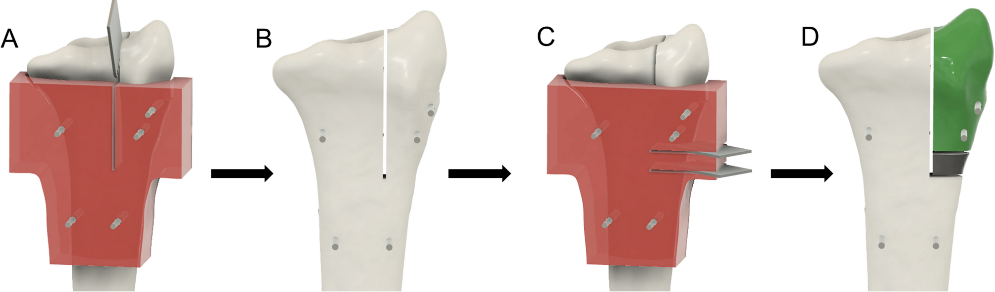 Comparison of 2D and 3D fluoroscopy for intraoperative detection of intra-articular incongruities in distal radius fractures