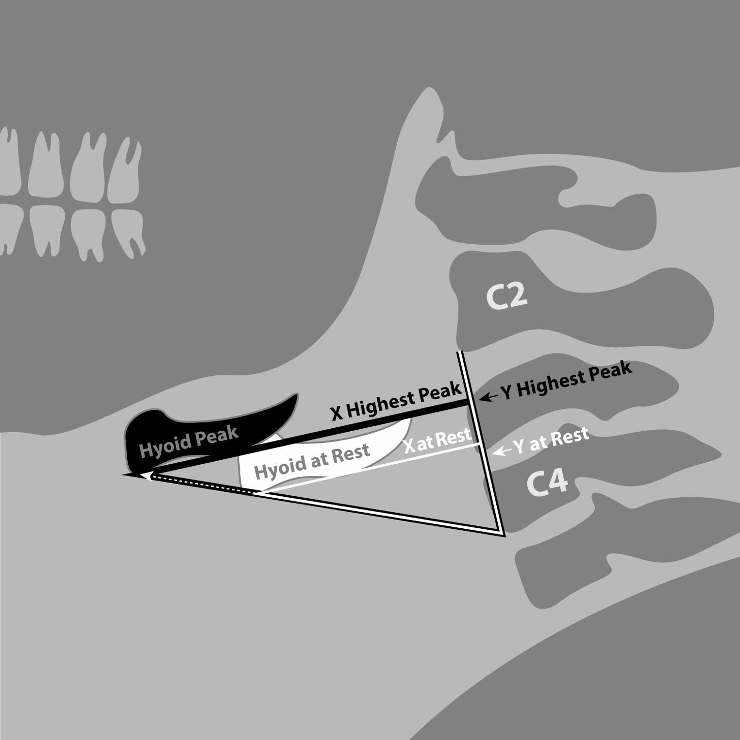 Palpation as a Method To Predict Spatial Instrumental Hyolaryngeal Excursion Measures